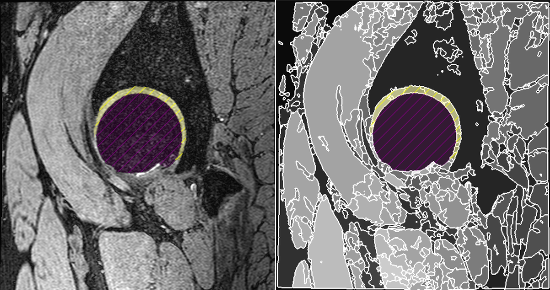 MRI scan showing a hip joint